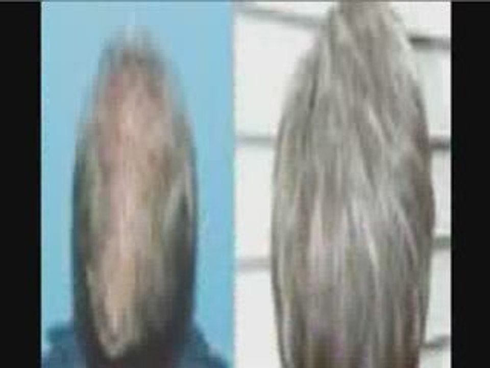 Provillus Hair Loss Before and After Pics