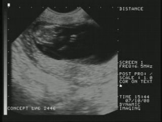 Echographie de mon bébé