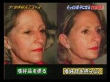 Twins Plastic Surgeon, Dr. Darrick E. Antell - in Japanese