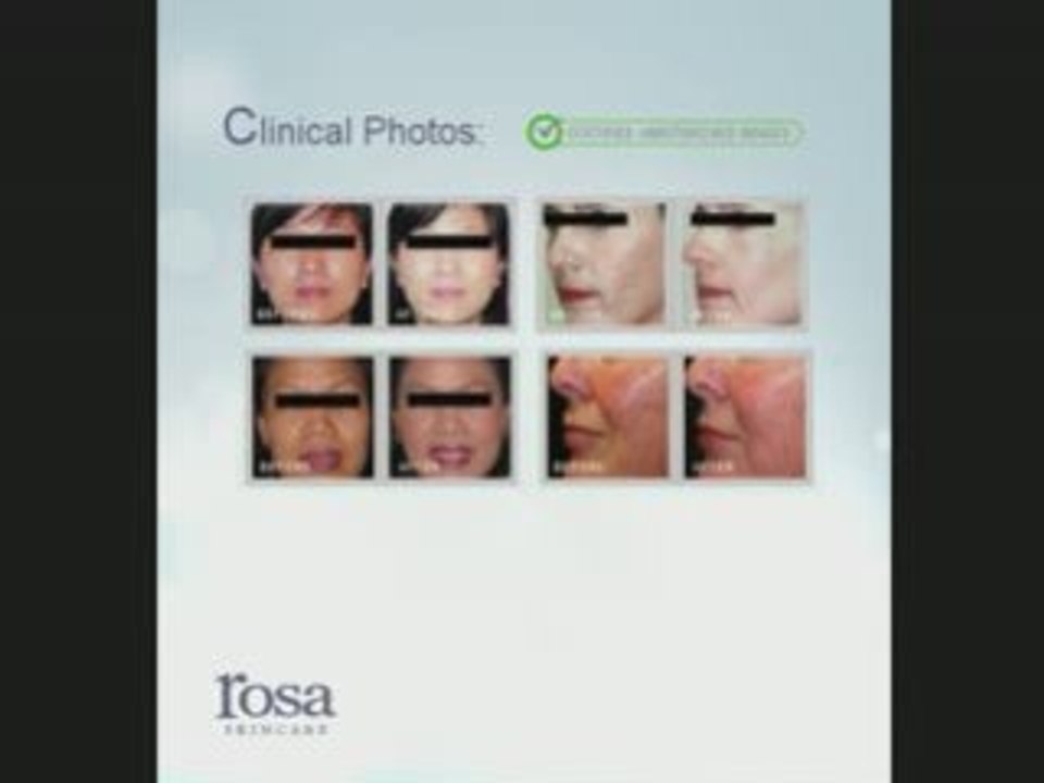 Skin Lightening for Hyperpigmentation