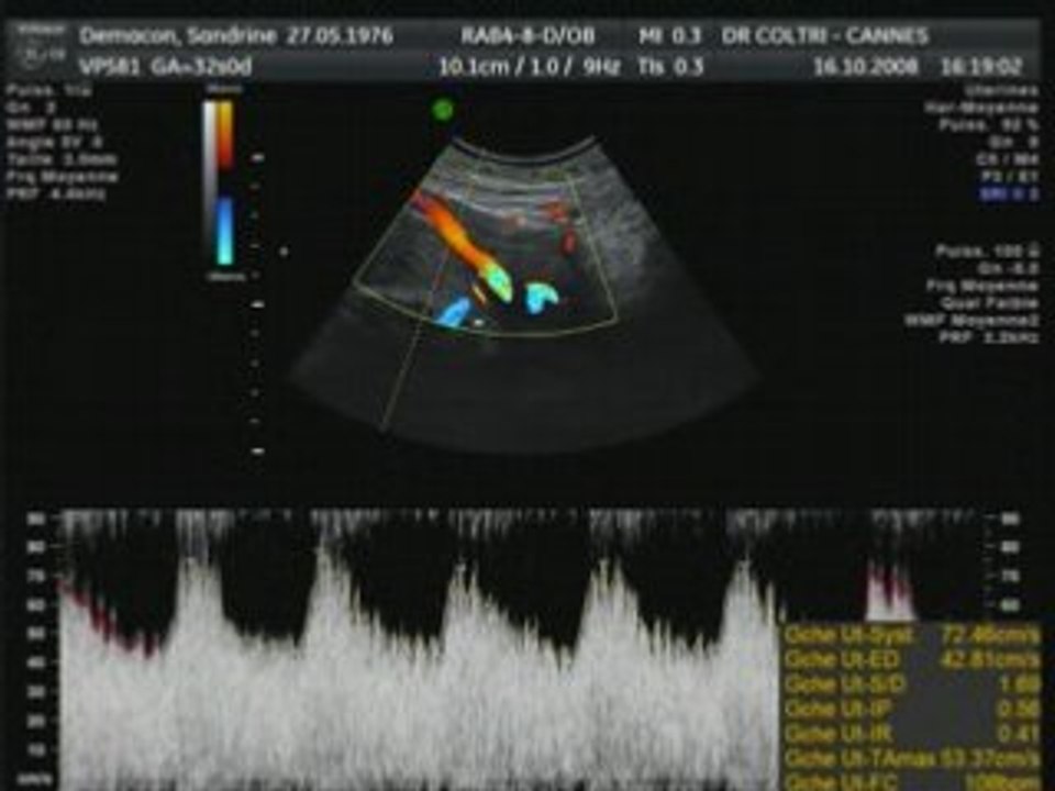 Bb jo 32 semaines de grossesse et 34 semaines d'amenhores
