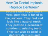 Dentures Are Replaced with Implants by Michigan Dentists