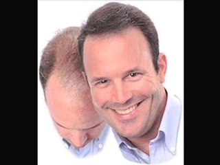 One of the best Male Hair Loss Treatments out there!
