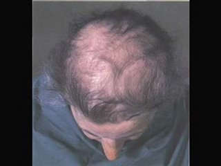 Try out this great Hair Loss Treatment