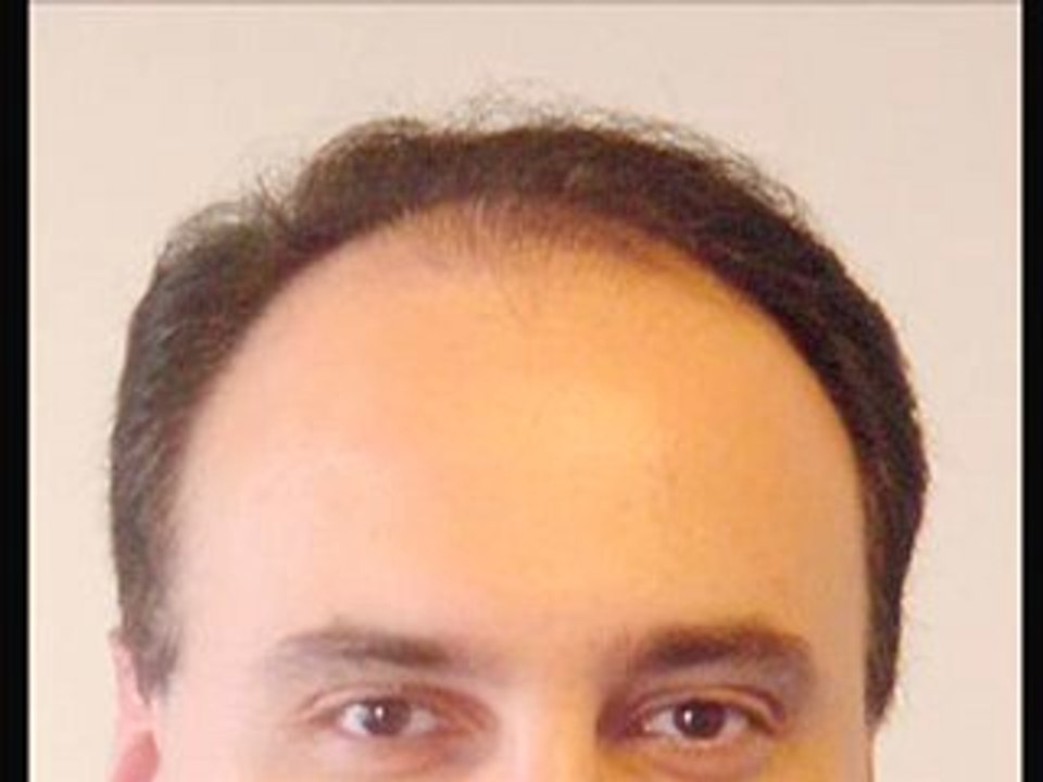 Your search for the best male hair loss treatment has ended!
