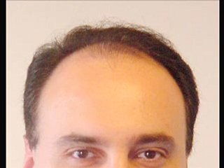 Your search for the best hair loss treatment has ended!