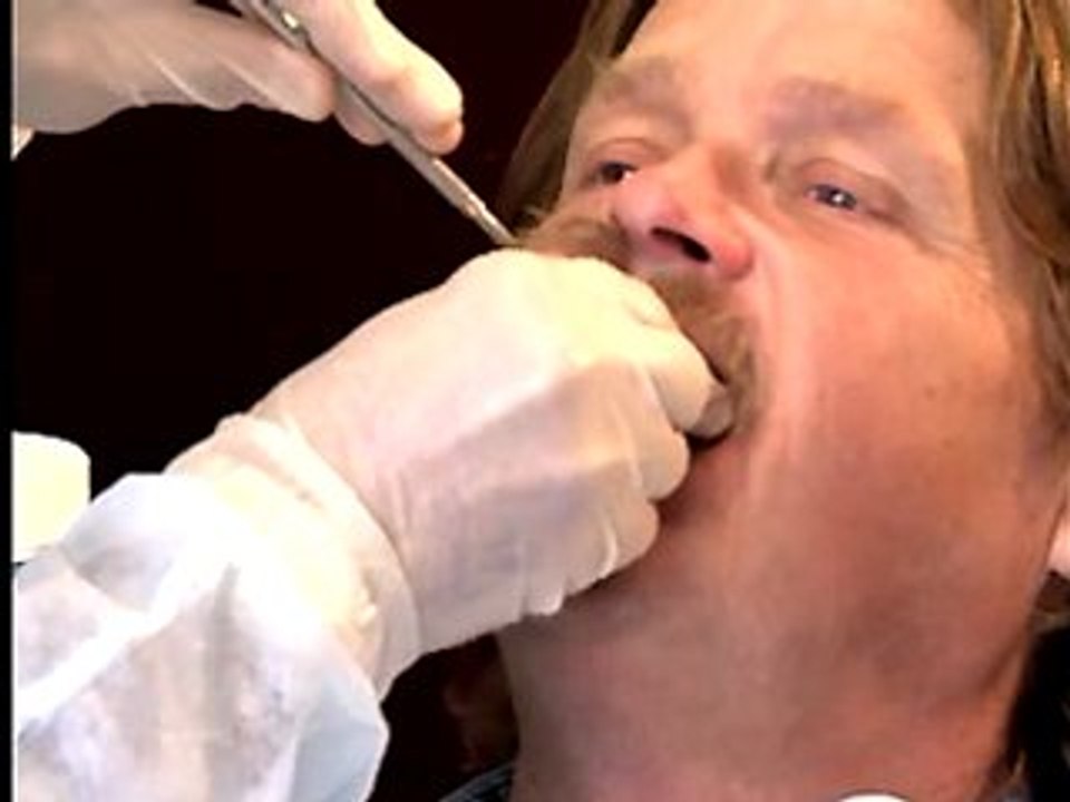 1-Maxillary_Preliminary_Impression-0