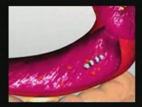 Systemic Enzymes used Against Uterine Fibroids