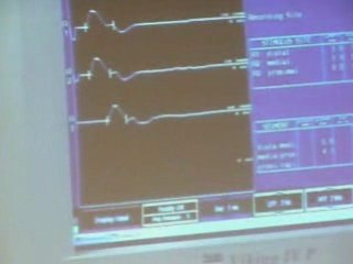 EMG pour tester le nerf médian cours pcem1