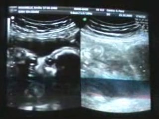 Tête, cervelet, orbites