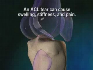 Anterior Cruciate Ligament