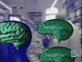Esquizofrenia: Atrofia cerebral (RM)