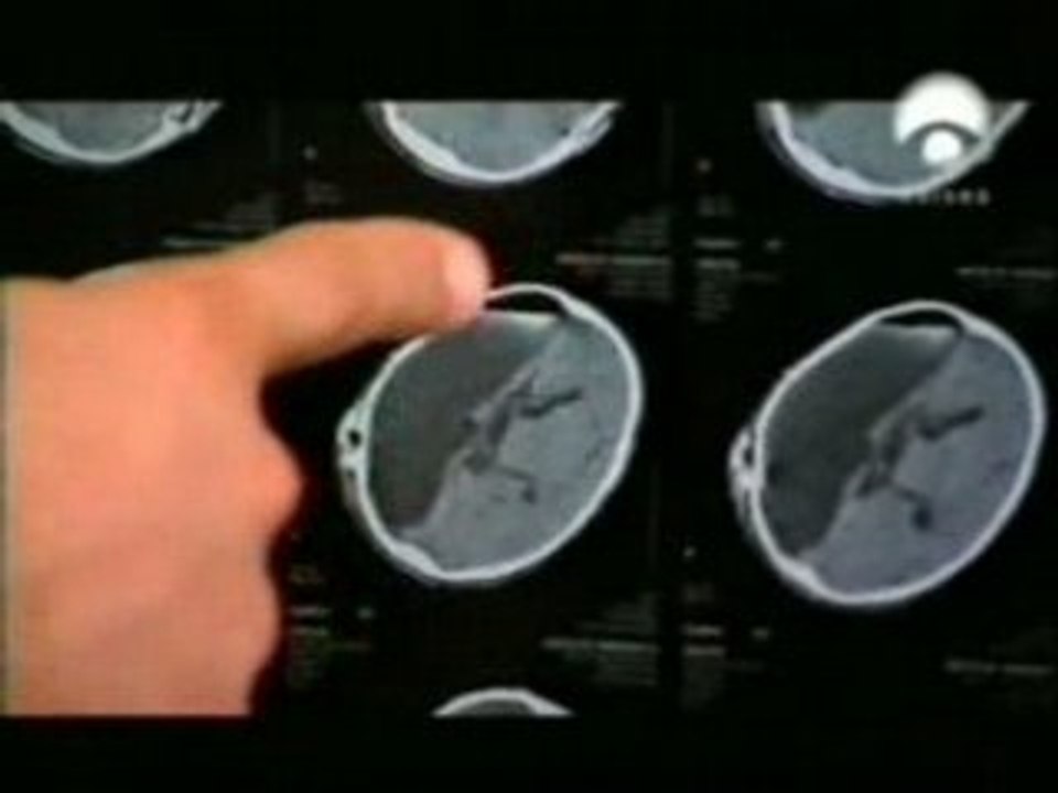 Epilepsia infantil: Split brain y hemisferectomia