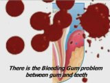 periodontal surgery,disease periodontal,infection gum