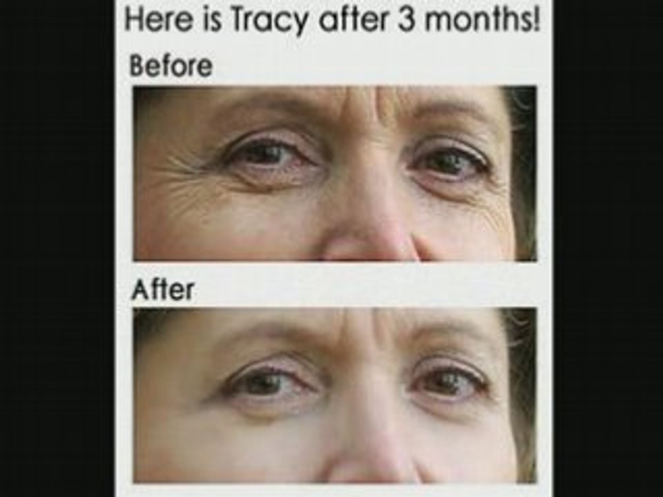 Is Caracol Cream a Scam?