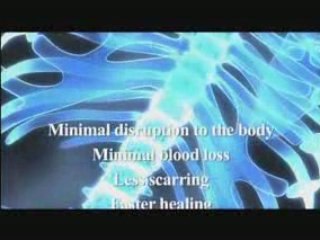 Lumbar spinal stenosis from Bonati