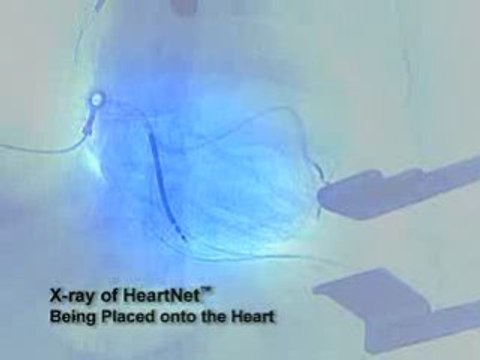 Enlarged Heart Animation