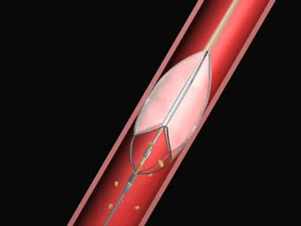 Baloon Angioplasty