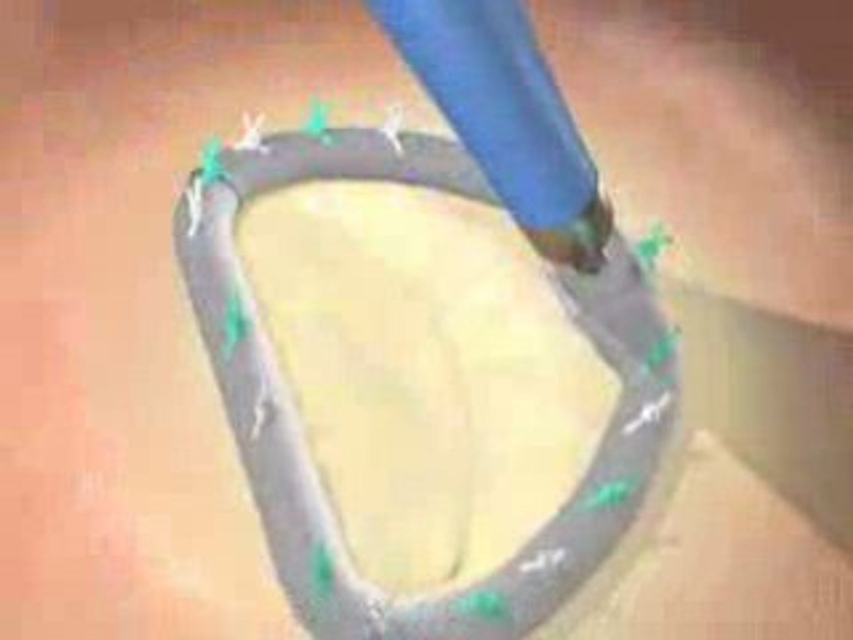 Prolapse Mitrail Valve Repair