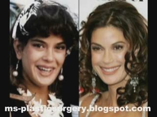 Plastic Surgery Before And After : The Key To  Successful