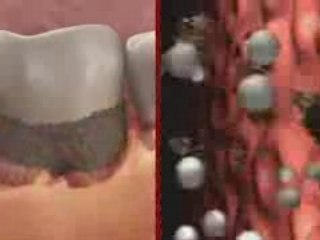 Pathologie des gencives, tartre et déchaussement des dents