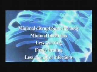 Surgery for spinal stenosis from Bonati