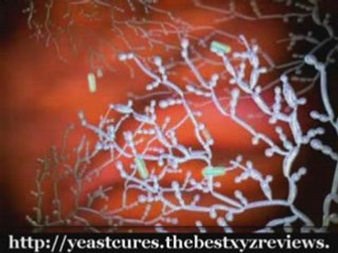 Yeast Infection Cures - Guaranteed!