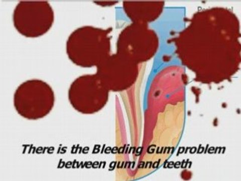 oral gum,periodontal treatment,swollen gum