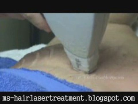 Tips Laser Hair Treatment Removal