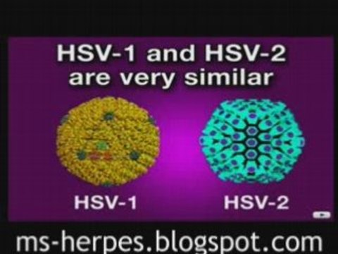 Herpes Complications : How To Kill The Herpes Simplex Virus