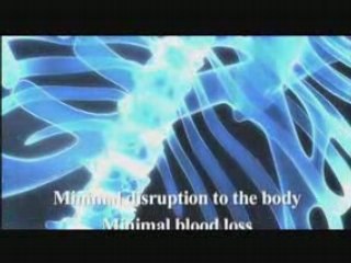 Lateral recess stenosis from Bonati