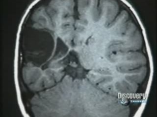 Epilepsia: Hemisferectomia y plasticidad cerebral