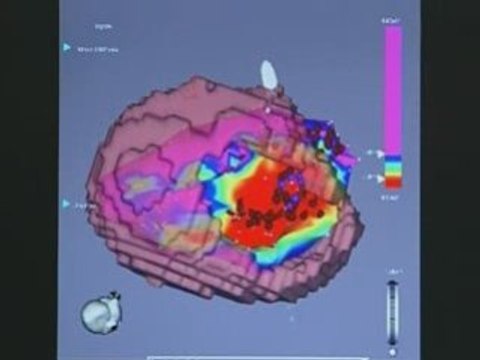 Heart Rhythm Abnormalities (Part 2)