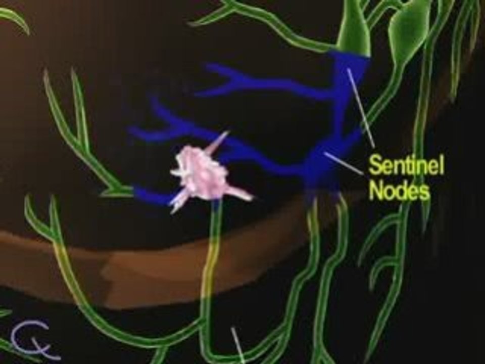 Sentinel Lymph Node Biopsy
