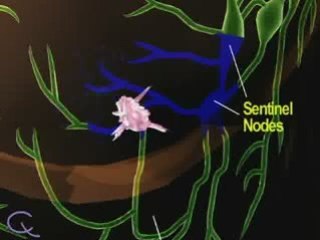 Sentinel Lymph Node Biopsy