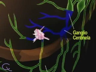 Biopsia del Ganglio Linfatico Centinela