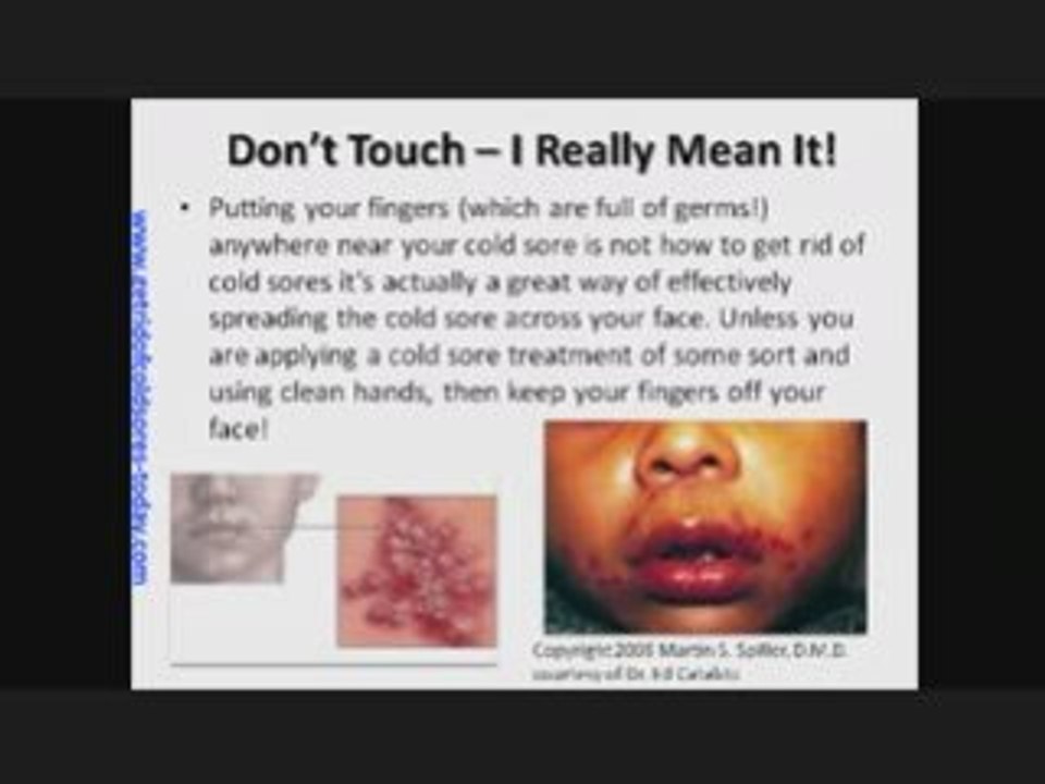 Remedies for Cold Sores  Grandmas Sure Fire Remedies for Col