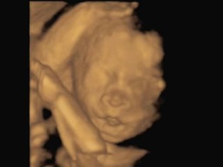 3D Ultrasound (espa