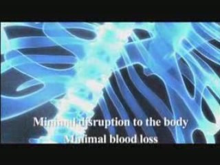 Degenerative disc disease