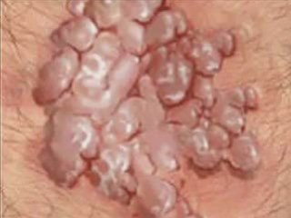 Proven Genital Warts Natural Treatment. Guaranteed Results!