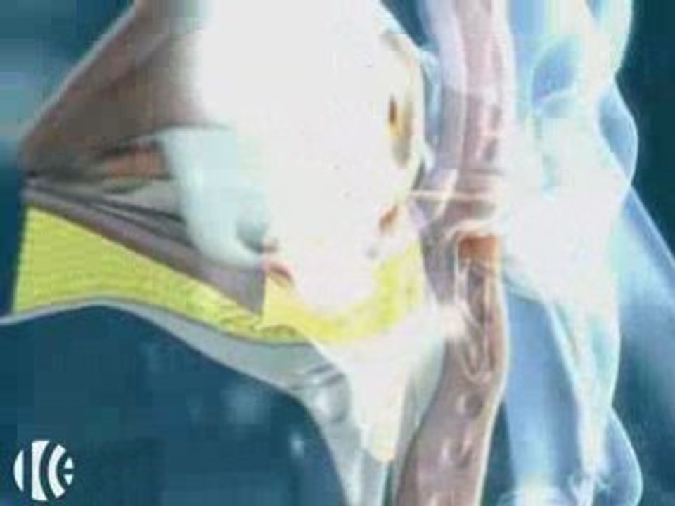 Blefaroplastia o Cirugía Estética de los Parpados