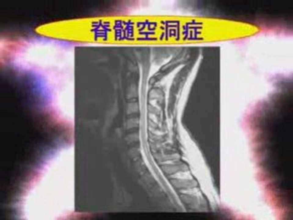Spine MRI in Japanese