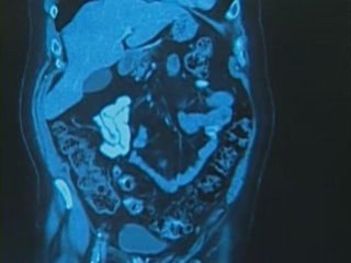 Colonoscopy and Death Rates