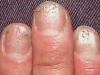 Moderate to Severe Psoriasis
