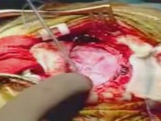 Cirurgia para tumor cerebral