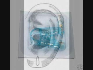 Split  Ear Lobe Repair in Atlanta Georgia