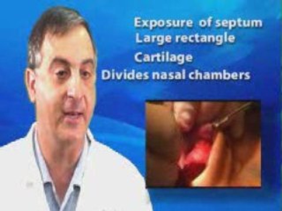 Rhinoplasty - Nasal Surgery