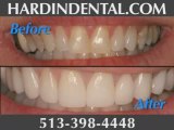 Teeth Whitening Cincinnati Ohio | Hardin Dental