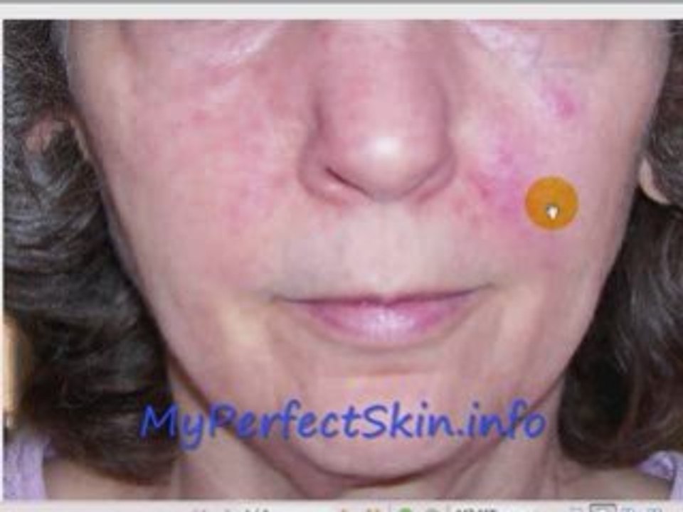 Puffy Reddish Skin?  Will Glimpse Help?