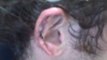 OTOPLASTY DALLAS (COSMETIC EAR PINNING):  HELIX ...